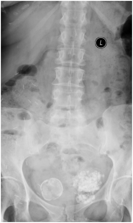 Are Calcified Uterine Fibroids Dangerous