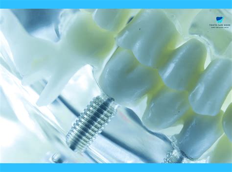 Are Titanium Implants Safe