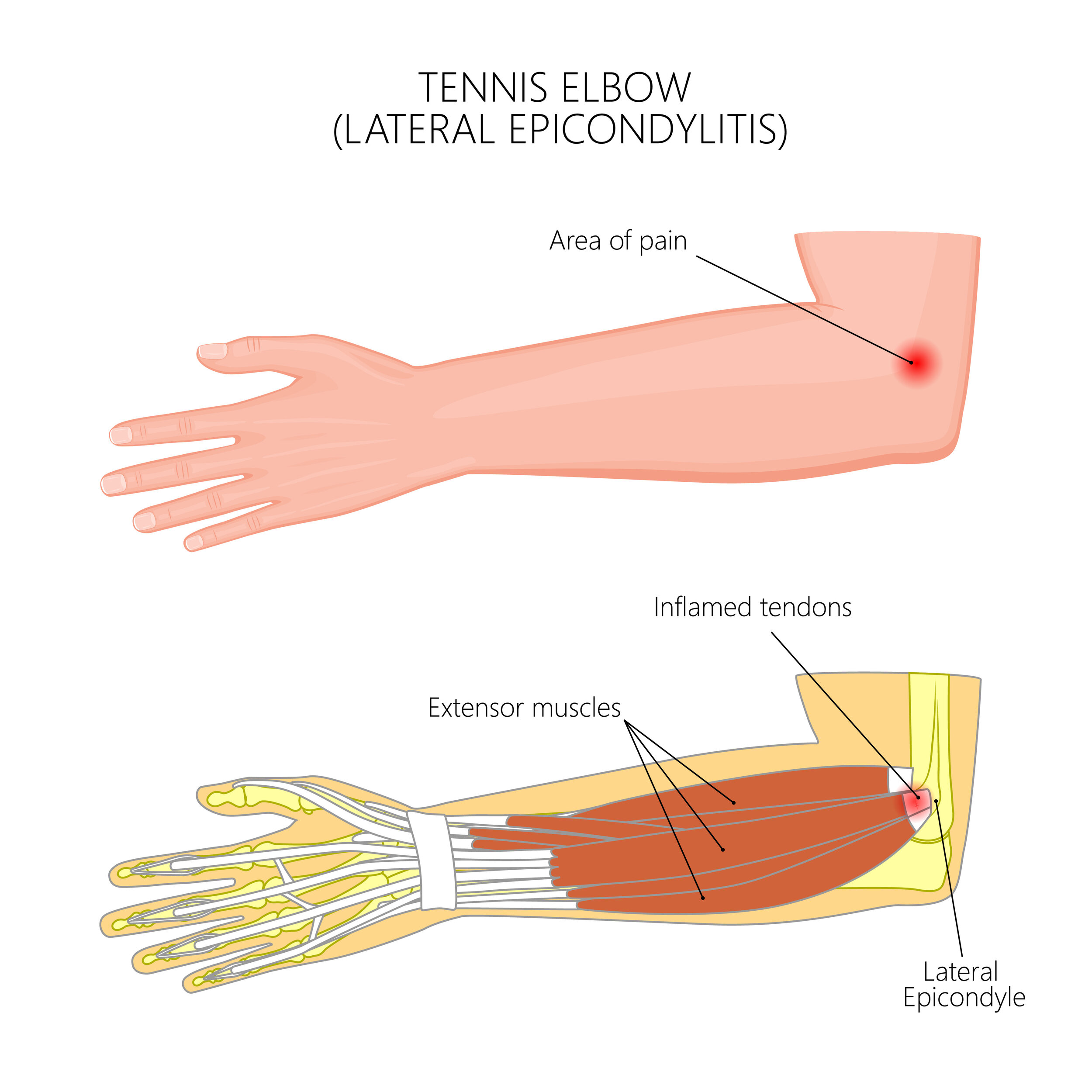 Ask A Physio Anything You Can Do About Tennis Elbow Ladner Village Ask A Physio Anything You Can Do About Tennis Elbow Ladner Village