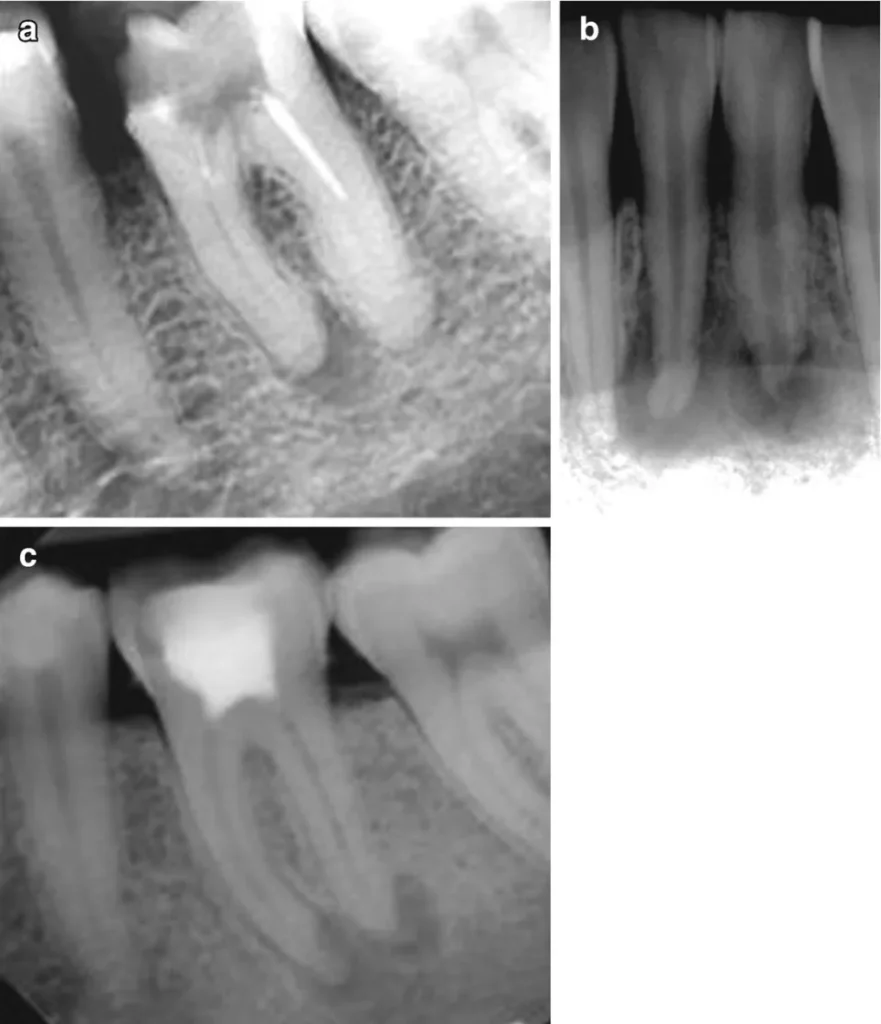 Asymptomatic Apical Periodontitis Explained
