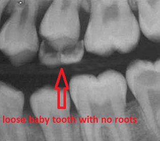 Baby Tooth Xray