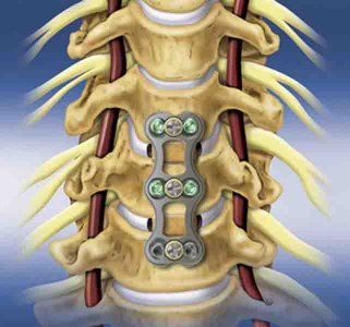 Back Pain After Microdiscectomy