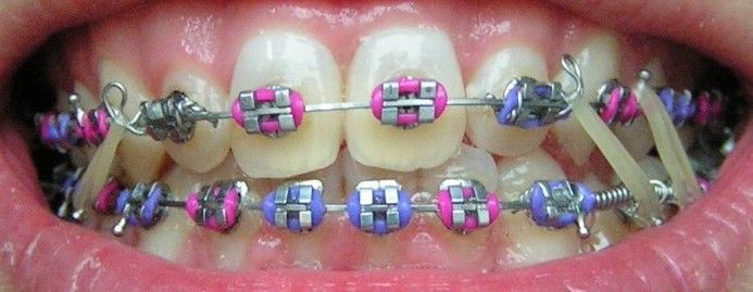 Best Colors For Braces Best Colors For Braces