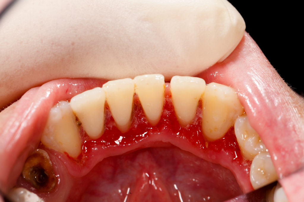 Best Dental Gum