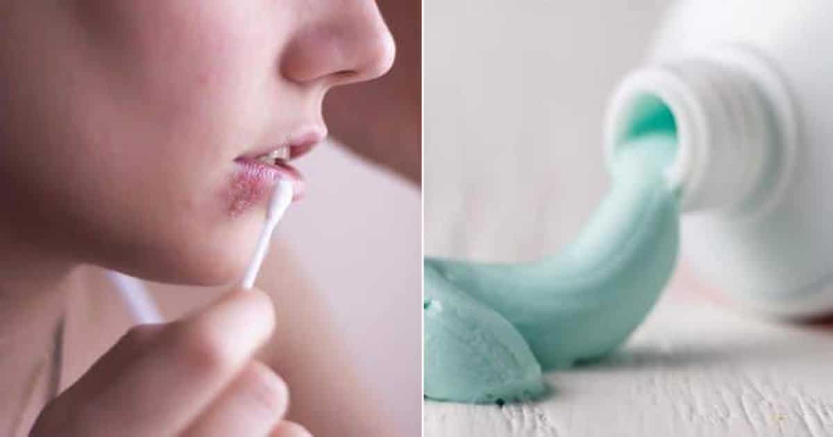 Best Toothpaste For Cold Sores