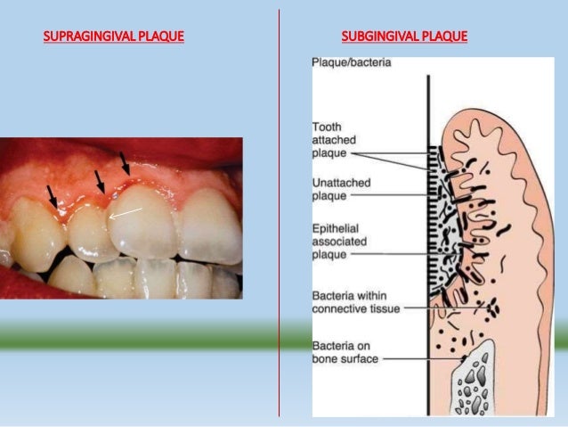 Biofilm Definition Dental