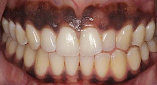 Black Dot On Gums
