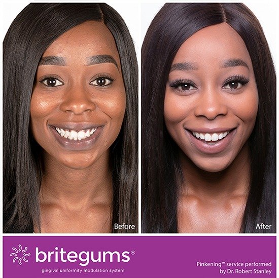 Black Gums Treatment At Home