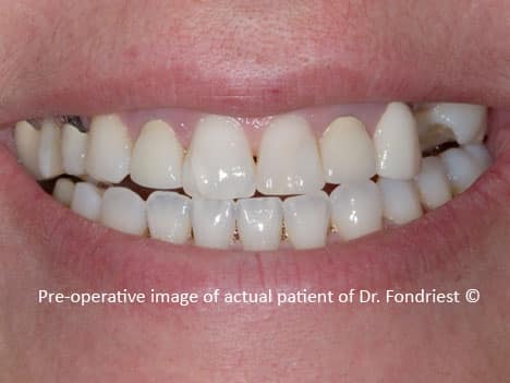Black Lines At Gumline Edge Of Crown Is Dark Black Spot On Gums Black Lines At Gumline Edge Of Crown Is Dark Black Spot On Gums