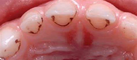 Black Lines In Back Teeth