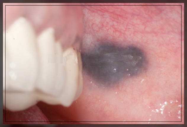 Black Spot In My Cheek