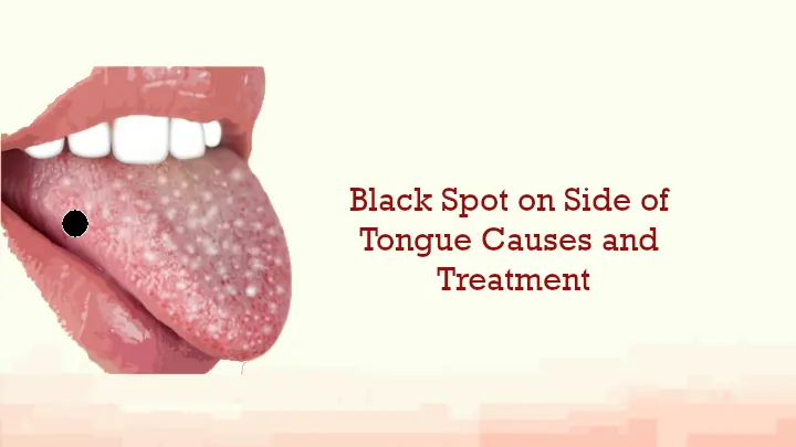 Black Spot On Tongue Causes Revealed