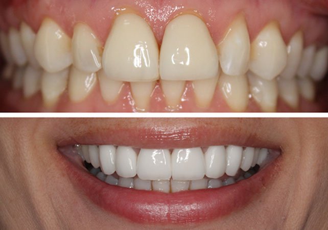 Black Triangle Teeth How To Fix Black Triangles Between Teeth Black Triangle Teeth How To Fix Black Triangles Between Teeth