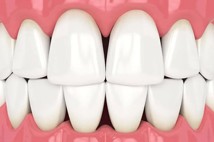 Black Triangles Teeth: Improve Smile Confidence