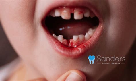 Bleeding Gums Toddler