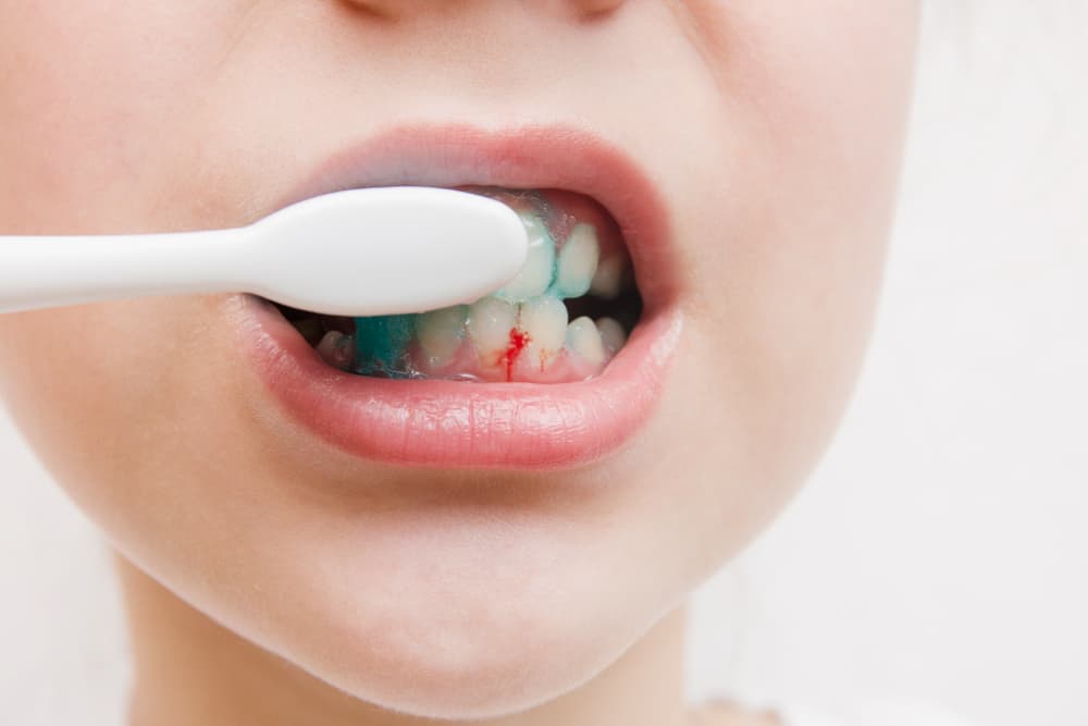 Bleeding While Flossing