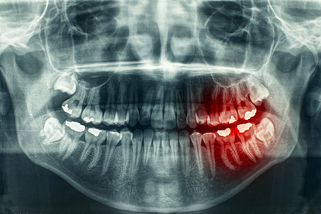 Blue In Teeth