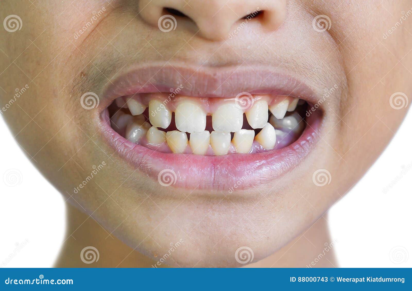 Bonding Front Teeth Gaps: Fast Smile Solution