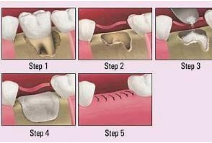 Bone Grafting Teeth