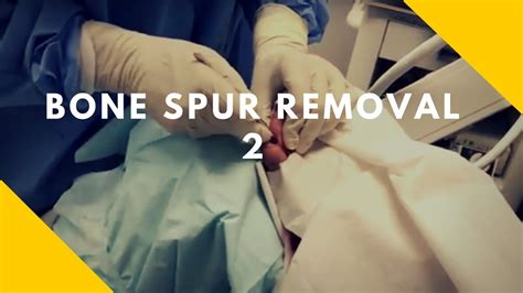 Bone Spur Extraction