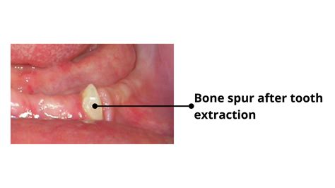 Bone Spur Wisdom Tooth: Easy Removal Solutions