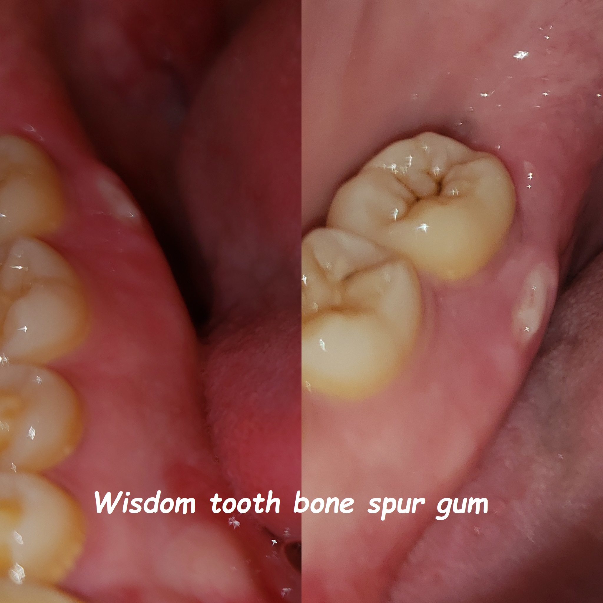 Bone Spur Wisdom Tooth: Relief Through Surgery