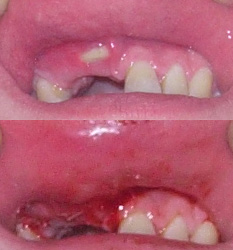Bone Spurs From Tooth Extraction