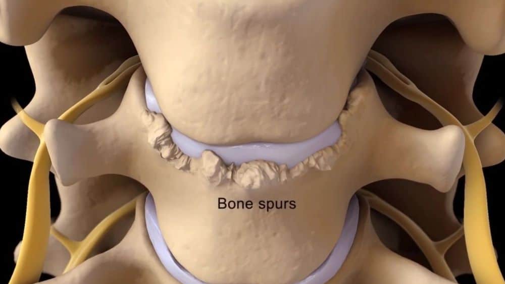 Bone Spurs In The Mouth