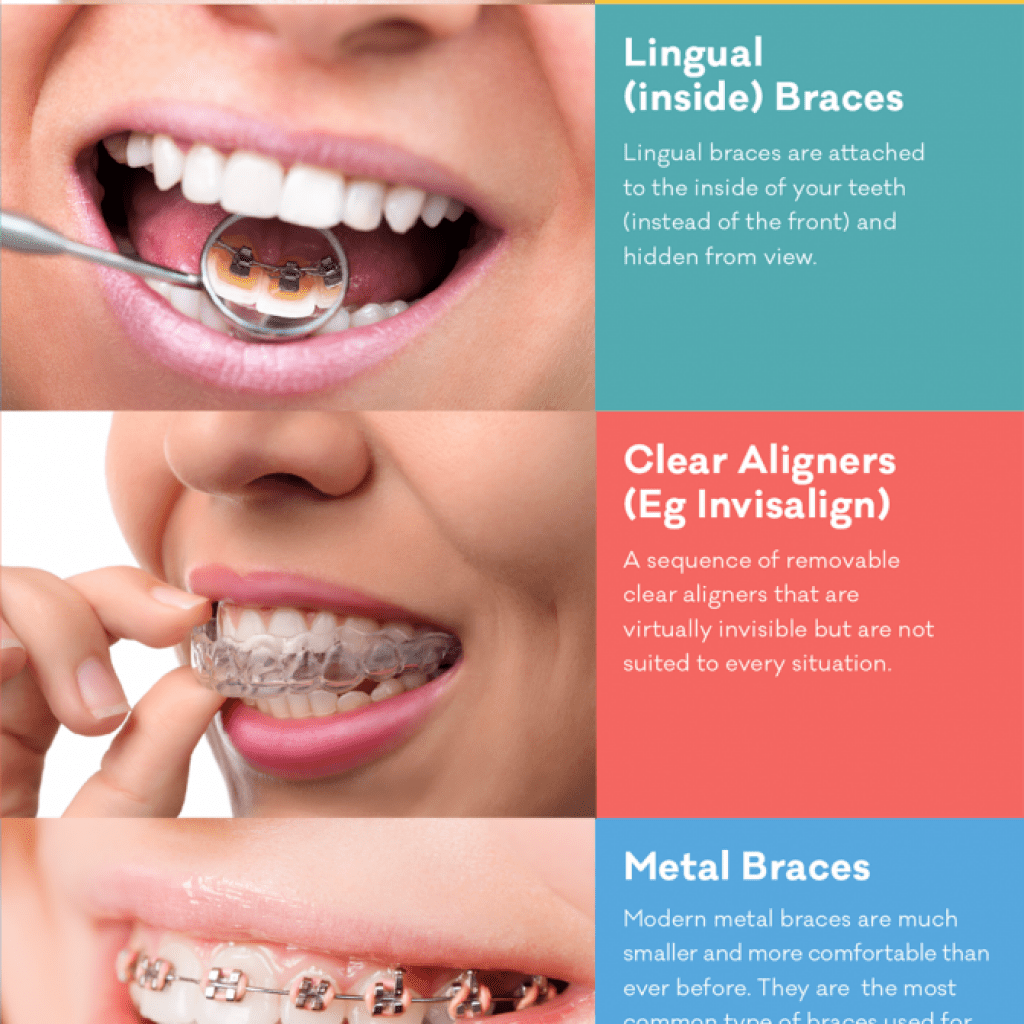 Braces Alternative: Fix Teeth Without Metal