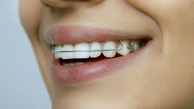 Braces And Gum Swelling