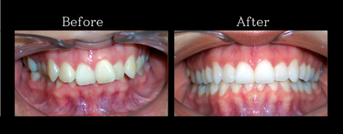 Braces Clear Aligner Kang Dental Braces Clear Aligner Kang Dental