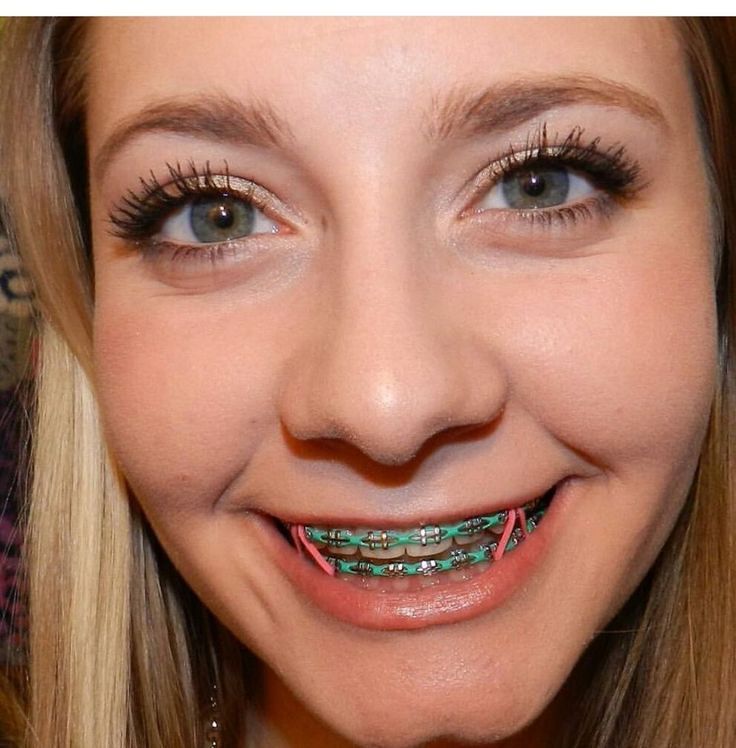 Braces Colors A Guide To Choosing The Best Braces Colors For Your Teeth Braces Colors A Guide To Choosing The Best Braces Colors For Your Teeth