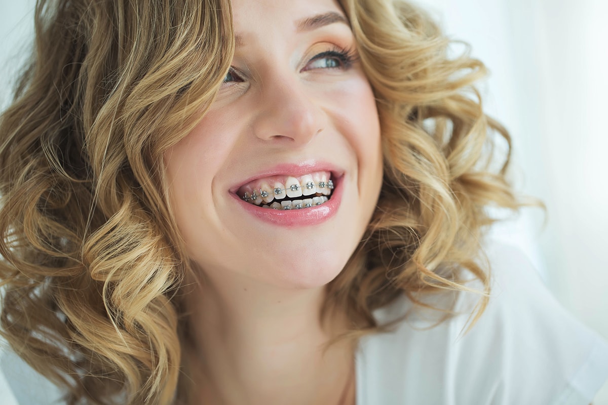 Braces For Adults: Achieve Perfect Smile Results Braces For Adults: Achieve Perfect Smile Results