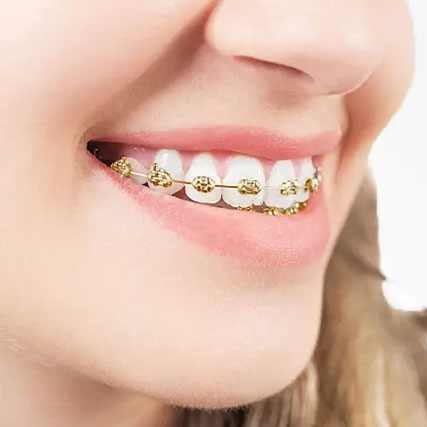 Braces Gold Color