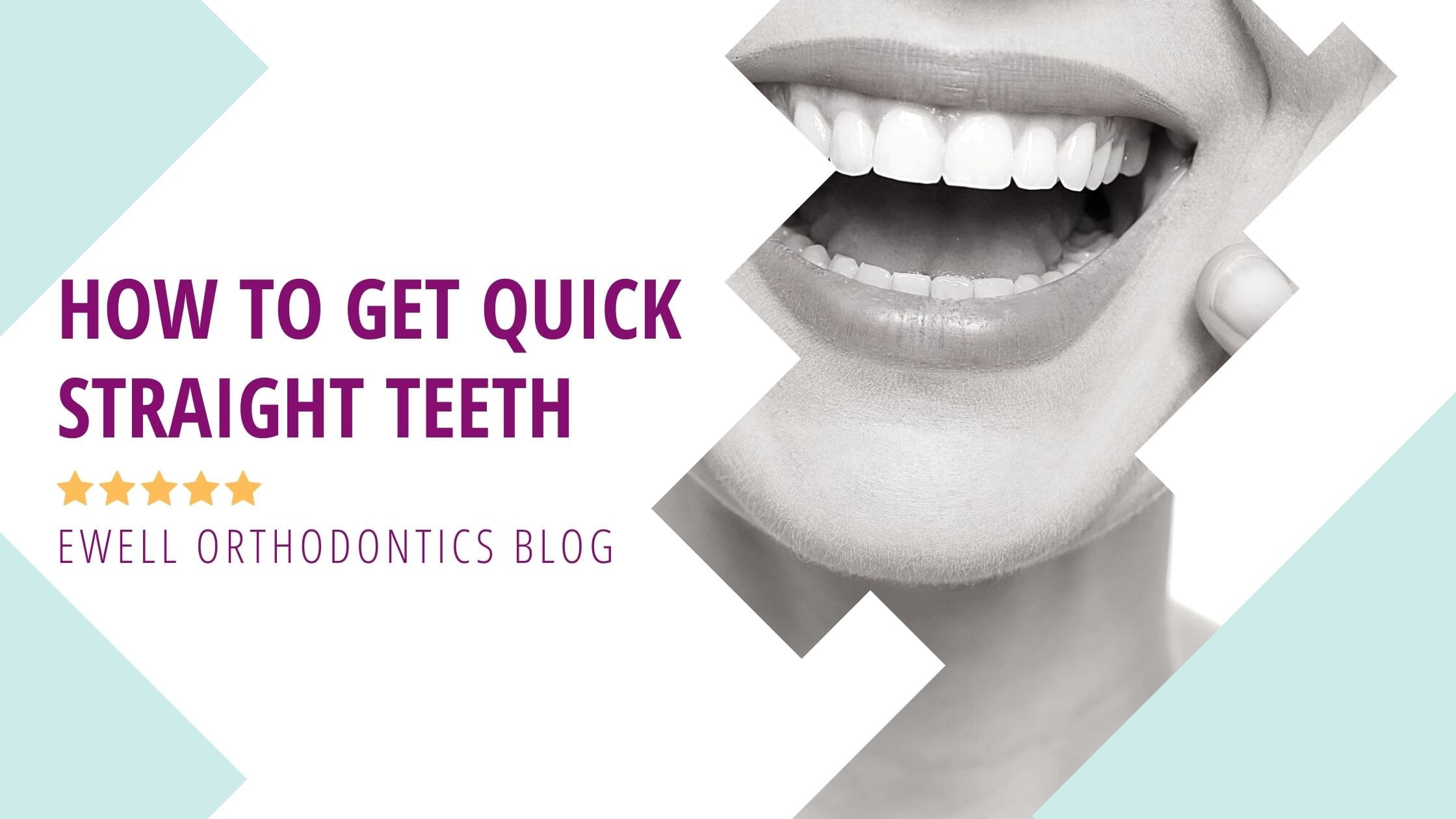 Braces Prices: Get Straight Teeth For $2,500