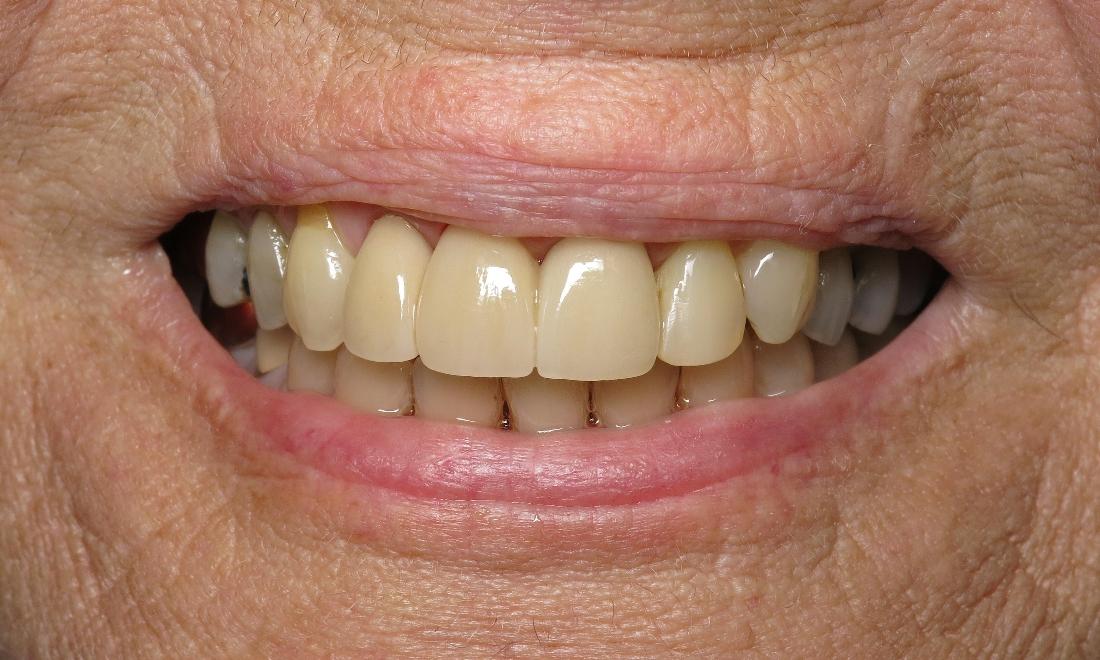 Bridge For Front Tooth