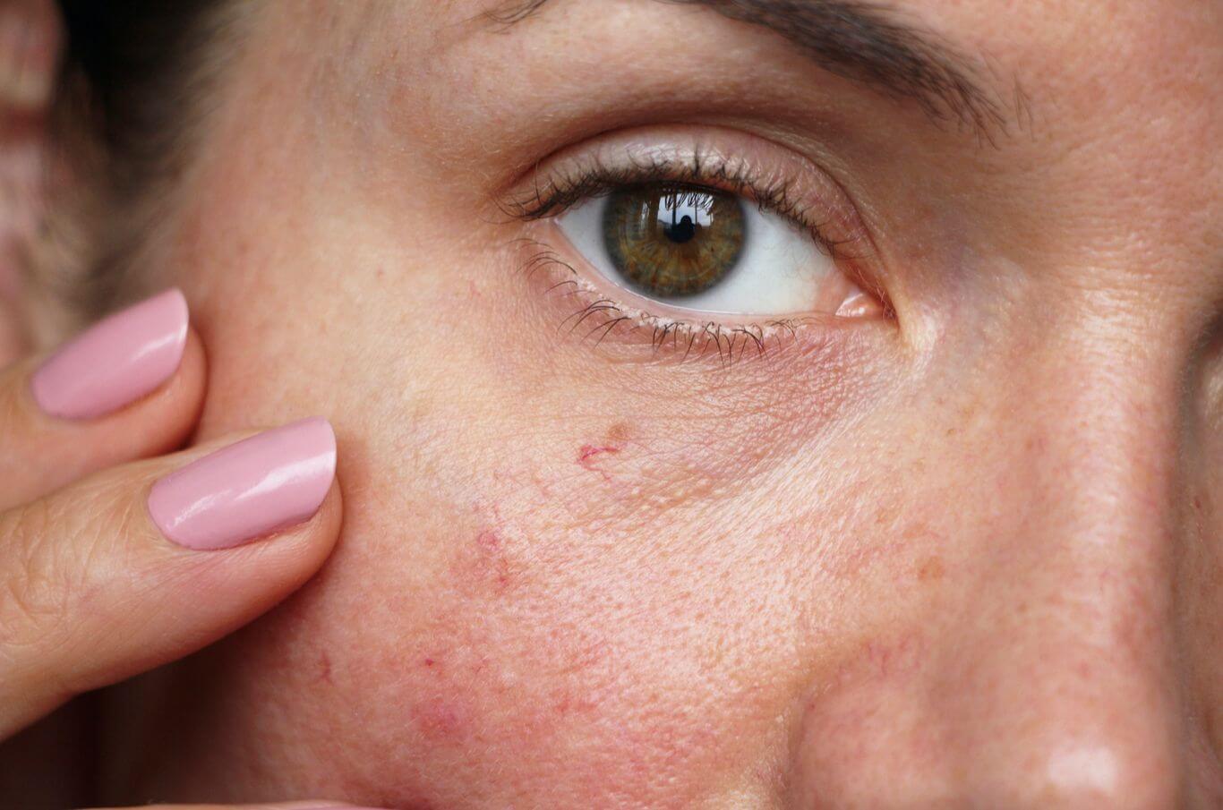 Broken Blood Vessel In Face