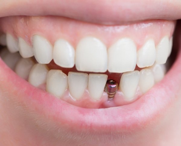 Broken Tooth Near Me