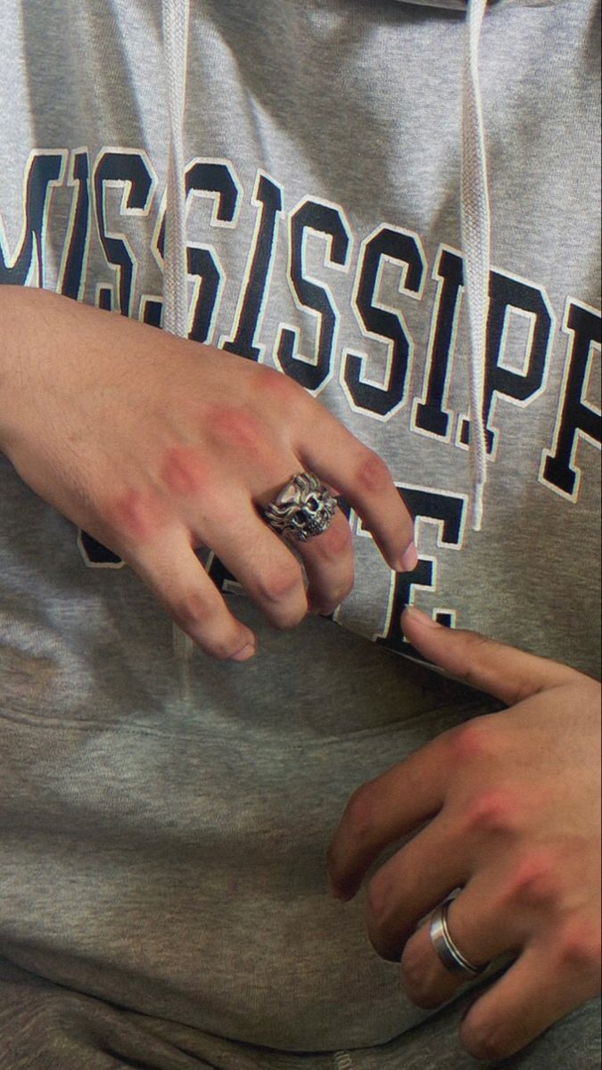 Bruise On The Hand