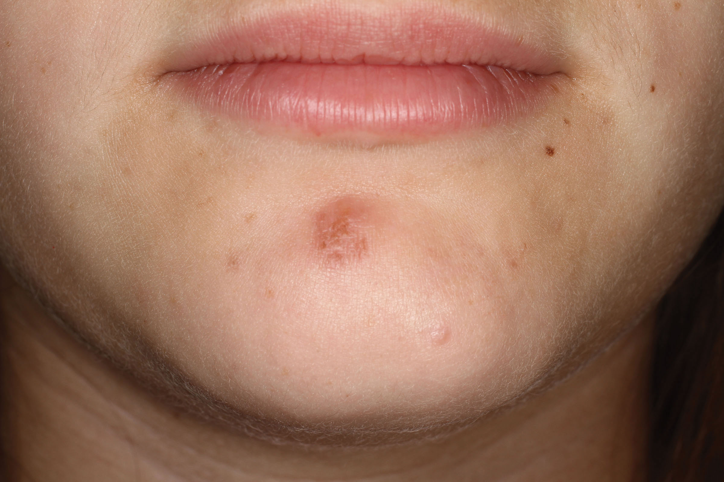 Bruising Around Lips