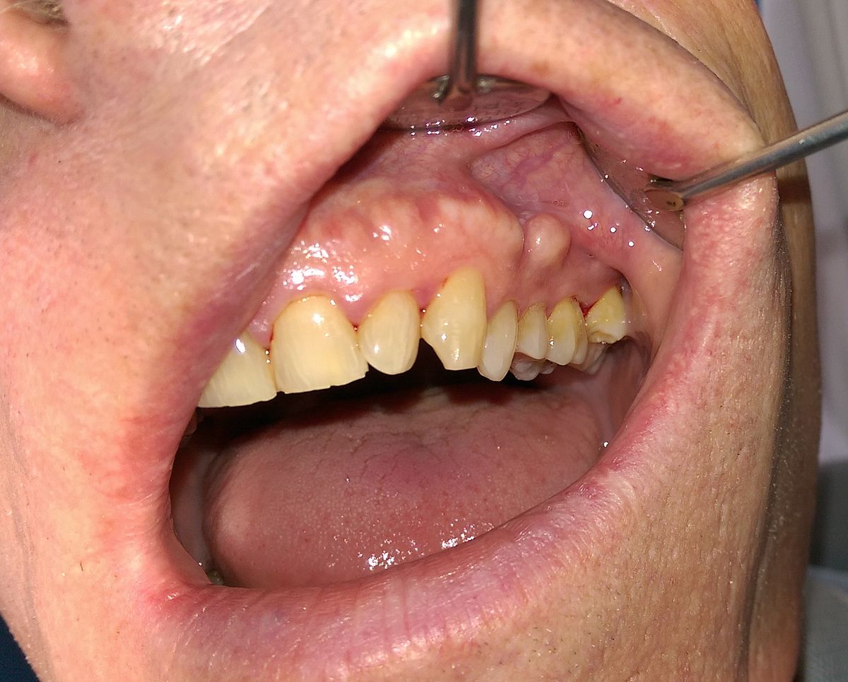 Buccal Exostosis Wikipedia Buccal Exostosis Wikipedia