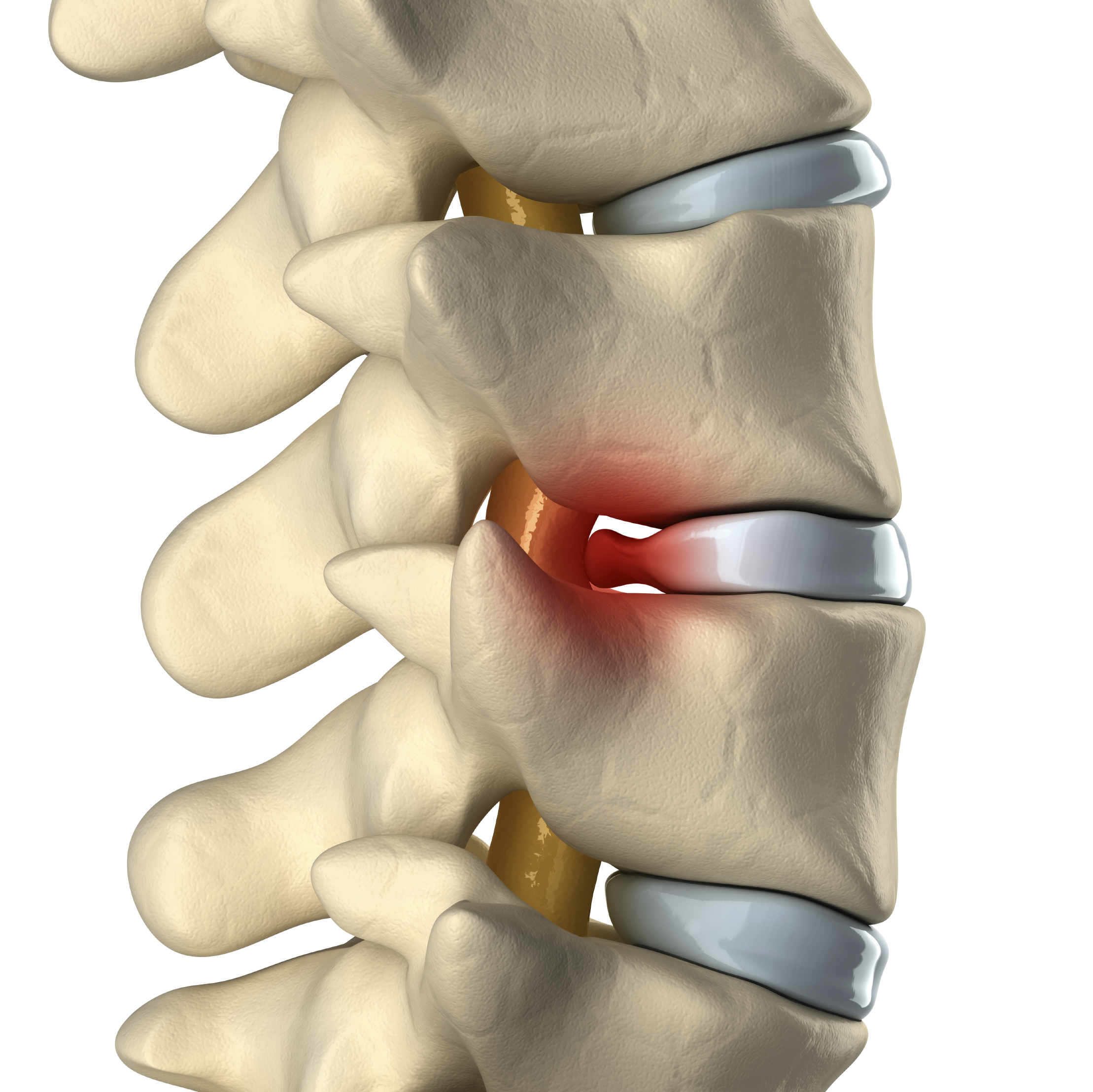 Bulging Disc Guide: Knee Pain Solutions