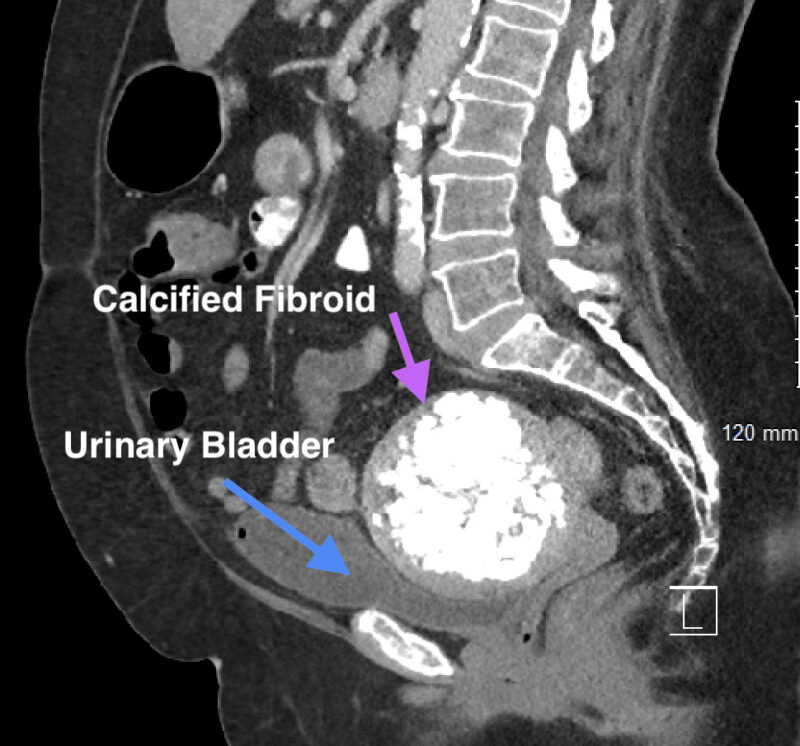 Calcified Fibroid: Symptoms & Treatment Options