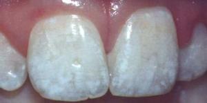 Calcium Marks On Teeth Calcium Marks On Teeth