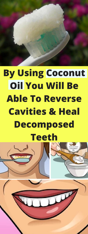 Can Coconut Oil Reverse Cavities