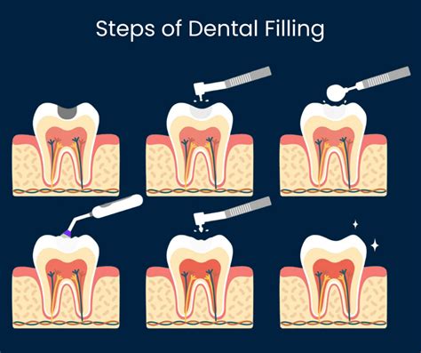 Can Fillings Hurt