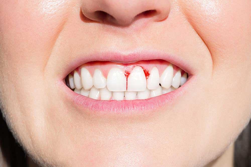 Can Gums Bruise