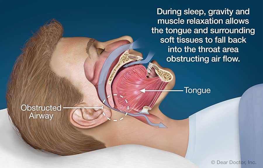 Can Snoring Cause Bad Breath