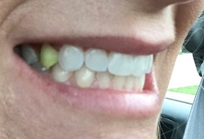 Can Tumeric Stain Teeth