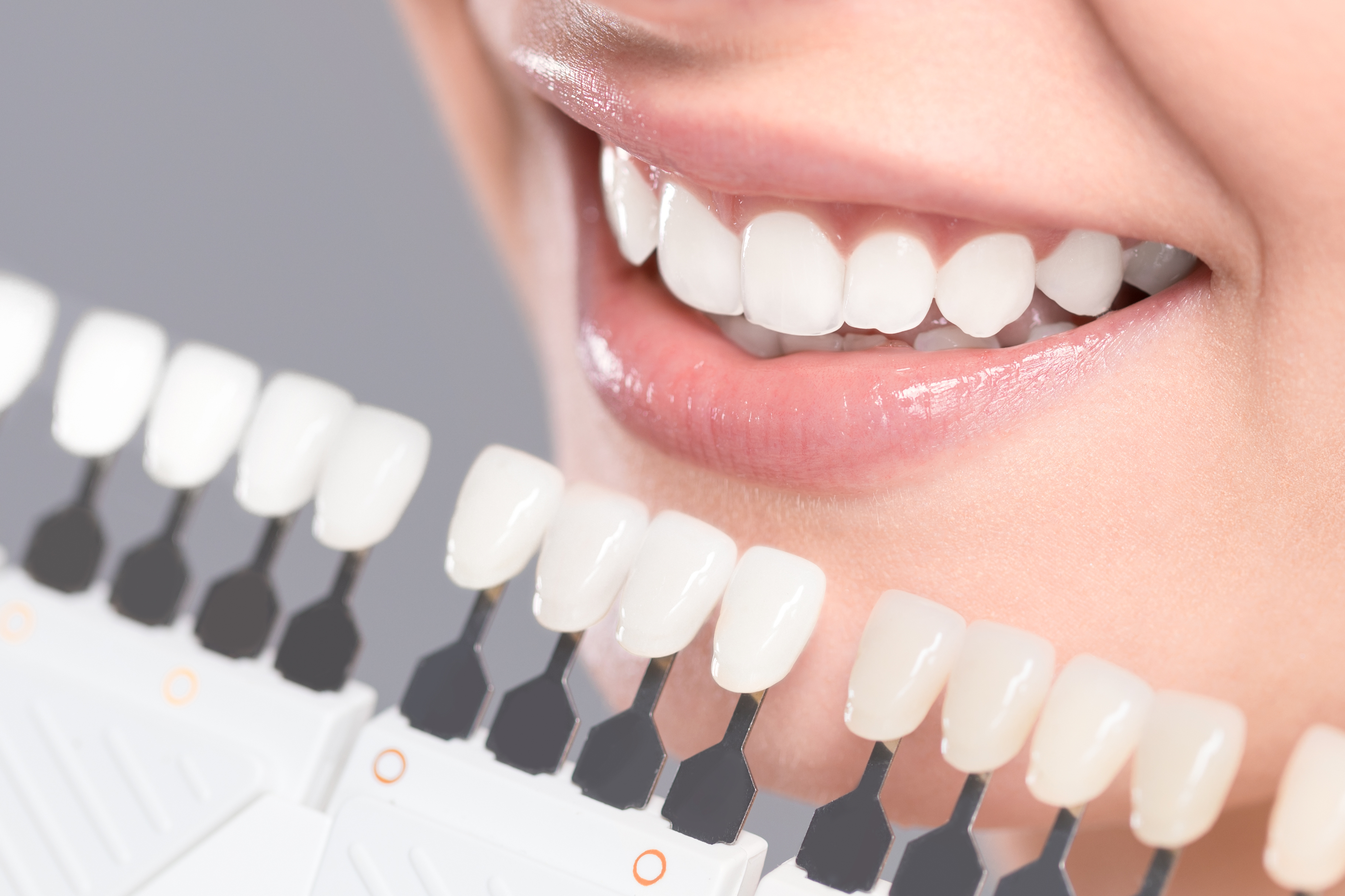 Can You Whiten Porcelain Crowns